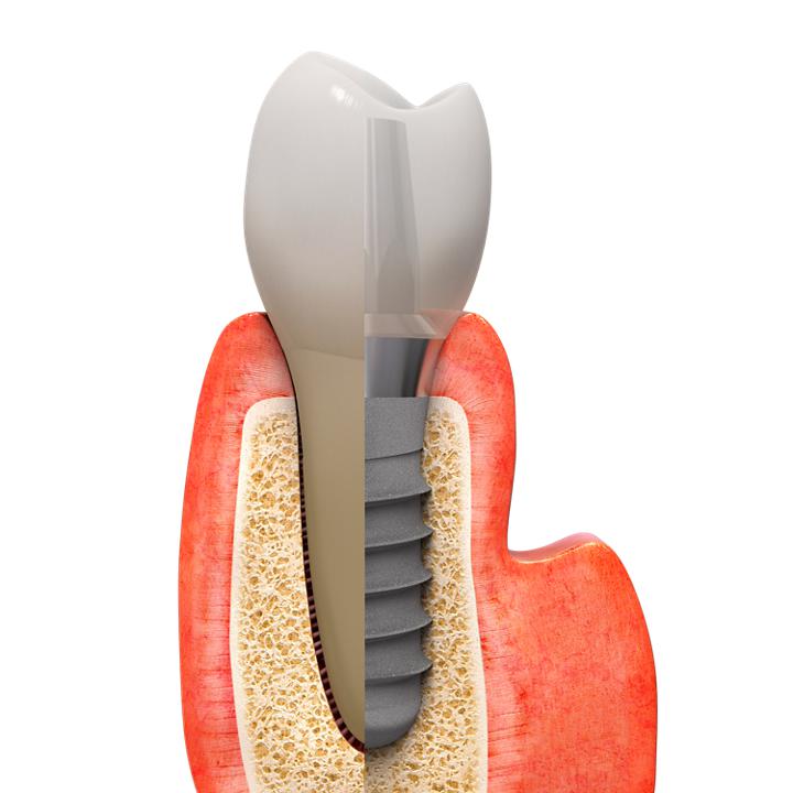 Implanturi Dentare Straumann